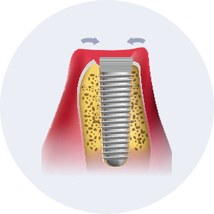Dental Implant Process image1